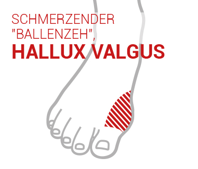 Hallux valgus